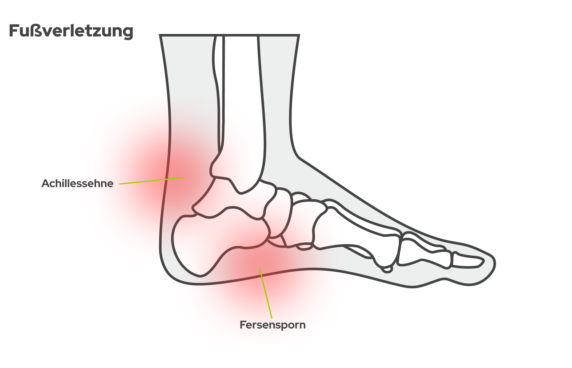 Bild Anatomische Grafik zeigt einen Fuß samt Knochenaufbau und zwei möglichen Schmerzstellen.