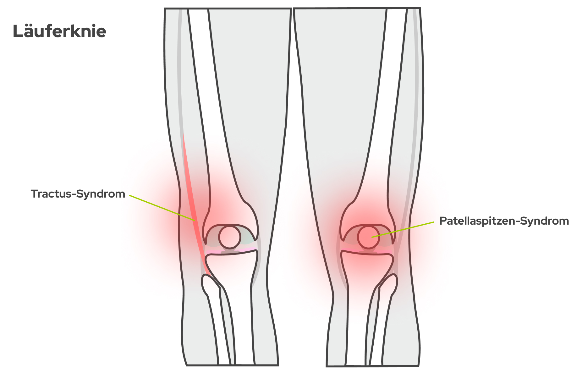 Bild Anatomische Grafik zeigt die Vorderansicht der Knie samt Knochenaufbau und zwei möglichen Schmerzstellen am Schienbein.