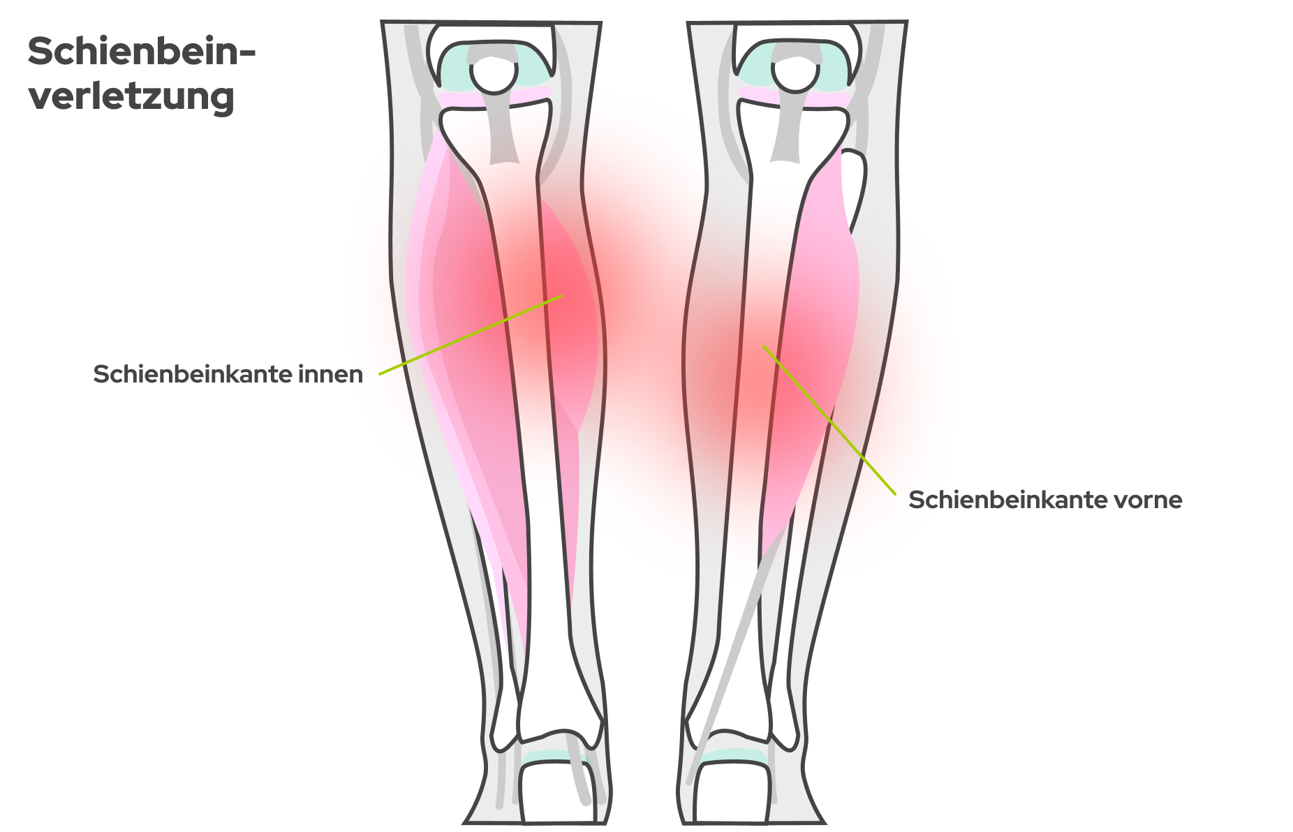 Bild Anatomische Grafik zeigt die Vorderansicht des unteren Beins samt Knochenaufbau und zwei möglichen Schmerzstellen am Schienbein.